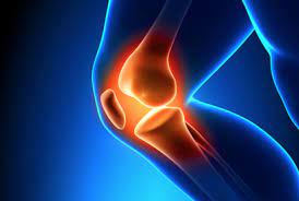 آرتروز زانو